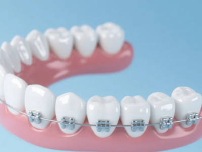 想做牙齒矯正，哪種方案更適合你？