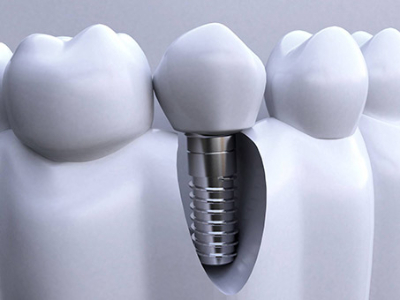 承德種植牙價格表，2024種植牙多少錢一顆呢?