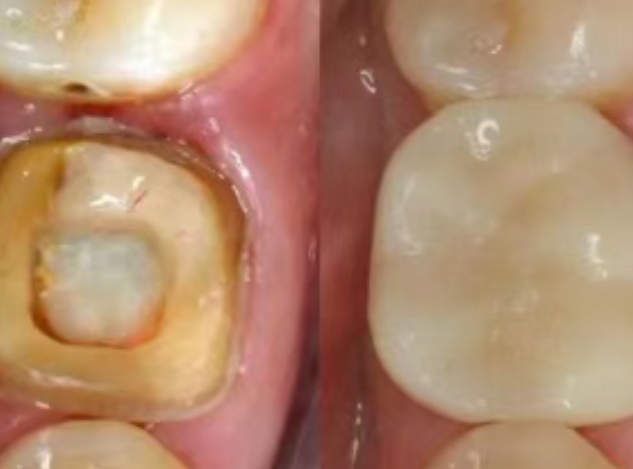 根管治療（抽神經）后，為什么一定要做牙冠？