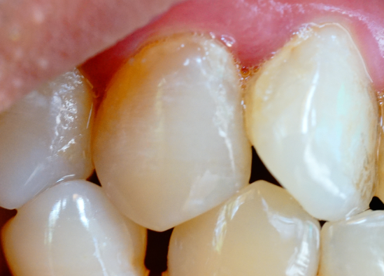 牙齒表面的牙釉質(zhì)掉了還可以修復(fù)嗎？