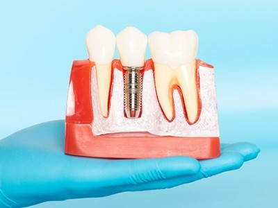 種牙VS鑲牙，你適合哪種?