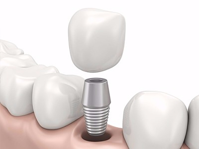 在承德哪家口腔醫(yī)院口腔種植齒好一點(diǎn)，惟德口腔醫(yī)院值得您的選擇