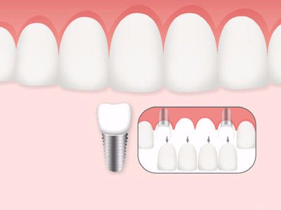 惟德口腔口腔種植怎么樣？惟德口腔就來為您一一解答