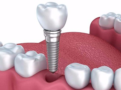 惟德口腔淺析口腔種植需要滿(mǎn)足哪些條件