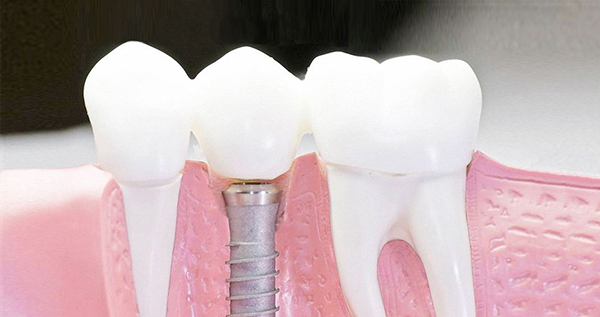 在承德口腔種植牙齒需要多少錢？惟德口腔一一為您道來