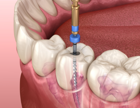 根管治療后的注意事項有哪些？